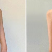 Scoliosi idiopatica: per la prima volta combinate due tecniche per la correzione di una grave scoliosi in una 15enne