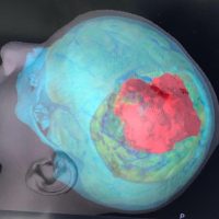 A Bari Sarcoma di Ewing al cranio rimosso con intervento ‘one step’