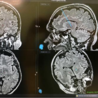 Malattia di Parkinson: al Belcolle di Viterbo impiantato il primo sistema di elettrocateteri direzionali per la stimolazione cerebrale profonda