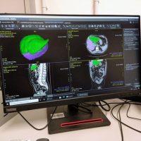 Patologia epatica: un nuovo software diagnostico all’AOU di Modena
