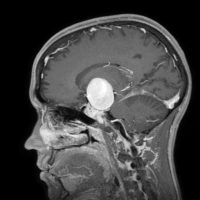 A Niguarda rimosso un aneurisma gigante all’interno dell’encefalo con l’uso di un esoscopio chirurgico in 3D