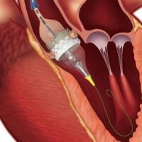 Il futuro dell’impianto delle protesi valvolari aortiche transcatetere al di fuori degli ospedali sede di una Cardiochirurgia