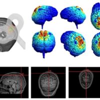 Alzheimer: la stimolazione magnetica rallenta la malattia