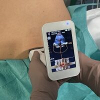 Al Poma di Mantova un ecografo a ultrasuoni 3D agevola l’anestesia epidurale e spinale