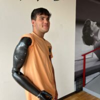 Braccio bionico: in Romagna intervento per controllare al meglio l’arto artificiale