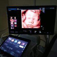 L’Irccs materno infantile “Burlo Garofolo” adotta una rivoluzionaria piattaforma ecografica con innovativa valutazione della funzionalità del miocardio