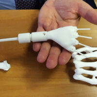 Un polso realizzato con una stampante 3D salva la mano destra di una neo-mamma