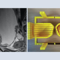 Tumore delle ovaie: un modello delle lesioni della singola paziente con la stampante 3D orienta le cure