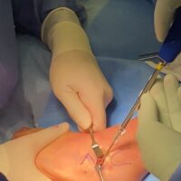 Chirurgia dei piedi piatti del bambino: le nuove viti nel materiale PLLA facilitano le fasi di guarigione