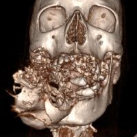 All’IRCCS Ospedale Galeazzi-Sant’Ambrogio asportato un ameloblastoma di un chilo e quattrocento grammi dal volto di un uomo