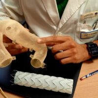 Chirurgia vascolare ‘di precisione’ con una protesi aortica ‘ritagliata’ su misura per il paziente