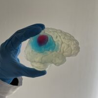 Bio3DModel realizza il cervello in stampa 3D per curare una paziente affetta da tumore cerebrale